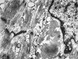 M,47y. | hypertrophic cardiomyopathy - left ventricle M,47y. | hypertrophic cardiomyopathy - left ventricle